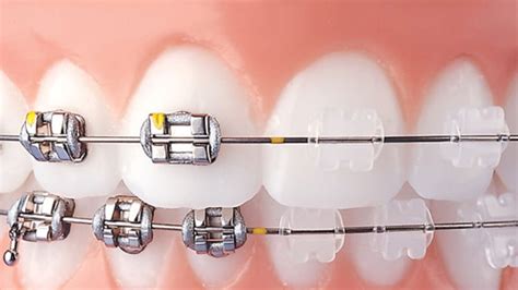 diferencia brackets metalicos y ceramicos|¿Cuál es la diferencia entre los brackets metálicos y los brackets .